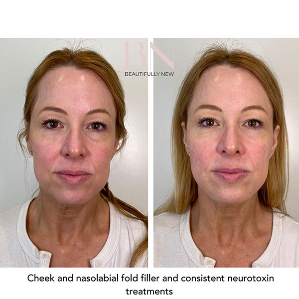 Cheek-Augmentation,-Dermal-Filler,-Neurotoxin-15-1