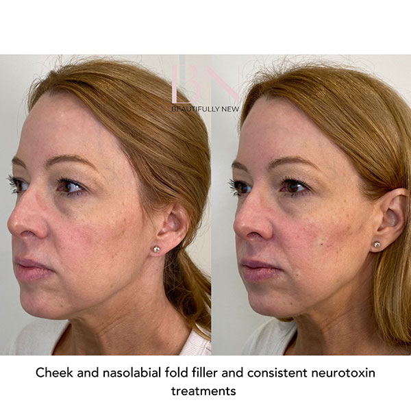 Cheek-Augmentation,-Dermal-Filler,-Neurotoxin-15-2