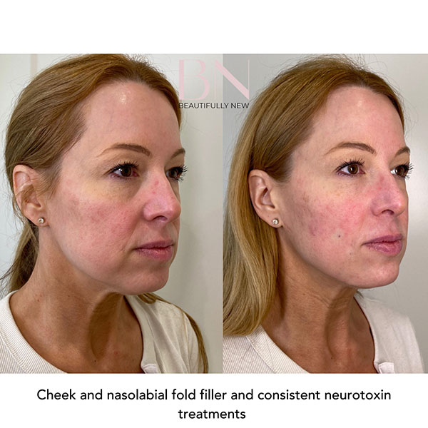 Cheek-Augmentation,-Dermal-Filler,-Neurotoxin-15-3
