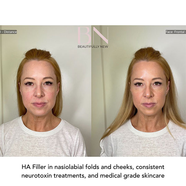 Neurotoxin,-Filler,-Cheek-Augmentation,-and-Skincare-1-1