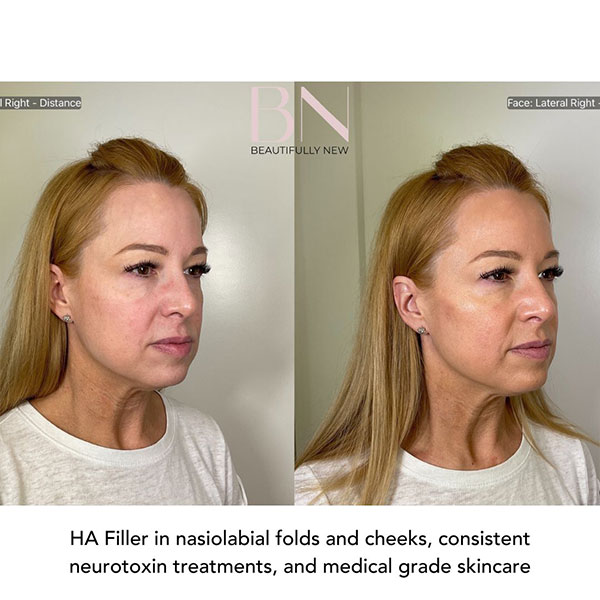 Neurotoxin,-Filler,-Cheek-Augmentation,-and-Skincare-1-2
