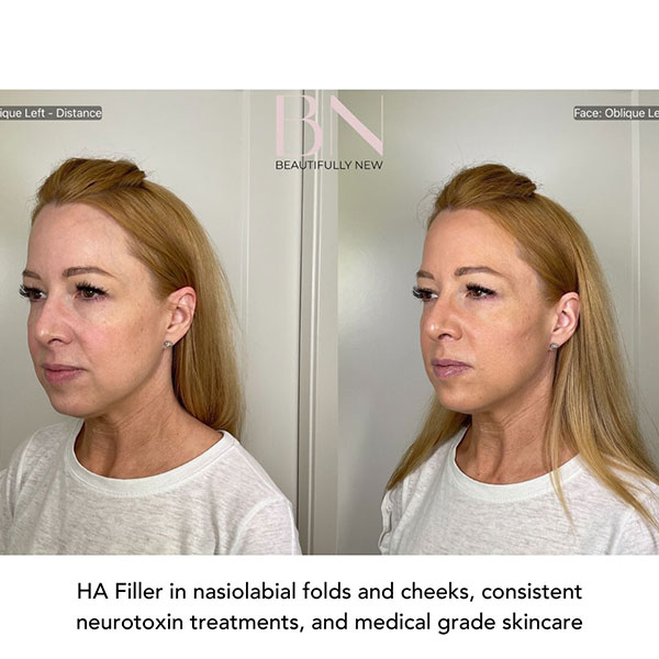 Neurotoxin,-Filler,-Cheek-Augmentation,-and-Skincare-1-3
