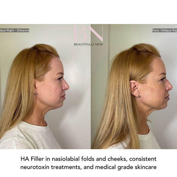 Neurotoxin,-Filler,-Cheek-Augmentation,-and-Skincare-1-5