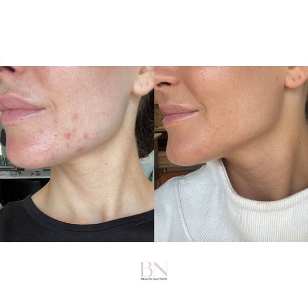 chemical-peel-diamond-glow-1a