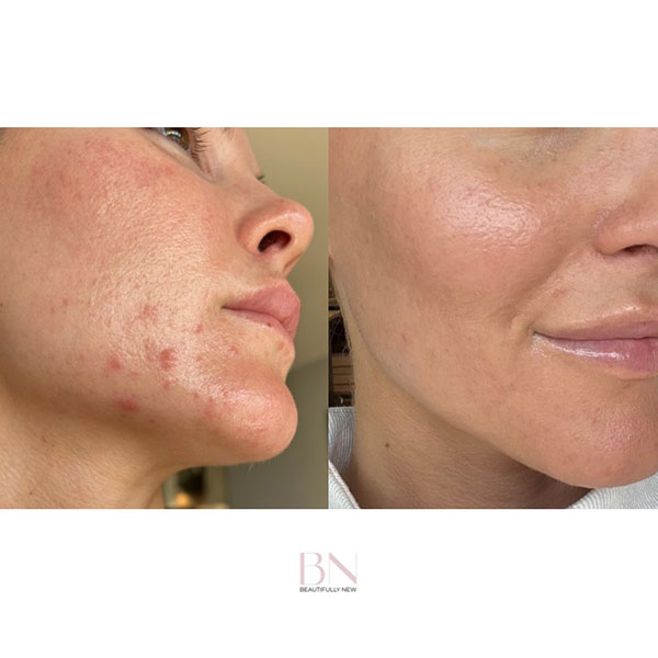 chemical-peel-diamond-glow-1b