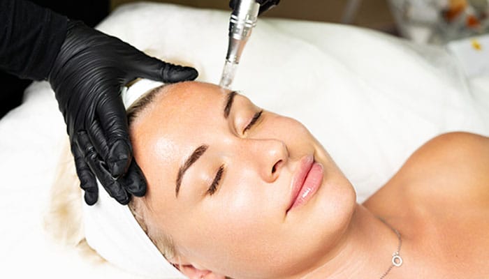 woman getting microneedling in Park Ridge, IL