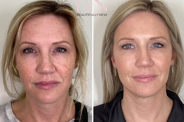 A woman shows before and after results from her Botox treatments in River North.