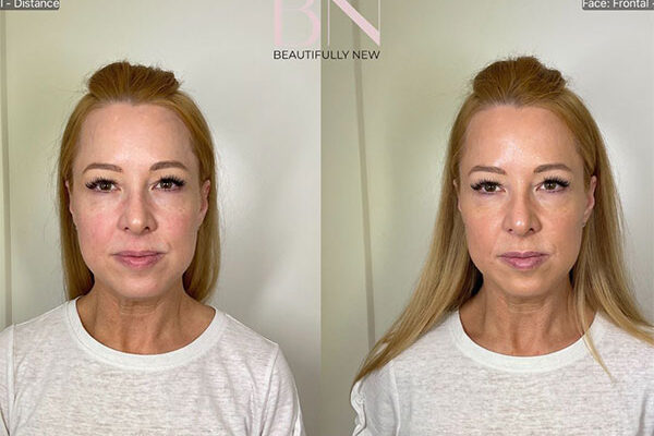 A woman's before and after results, which includes Botox in River North.
